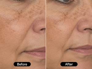 Faded hyperpigmentation and more even skin tone in 3 weeks.