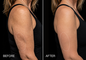 Smoother-Looking Lines in 3 Weeks.