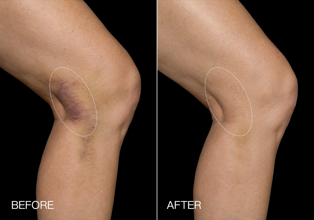 Noticeable Relief in 7 Days.