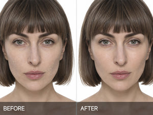 Clear Acnes and Pigmentation in 7 Days.